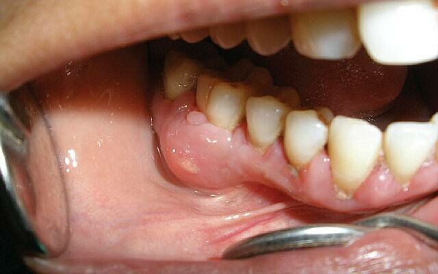Воспаление надкостницы зуба: лечение на всех стадиях